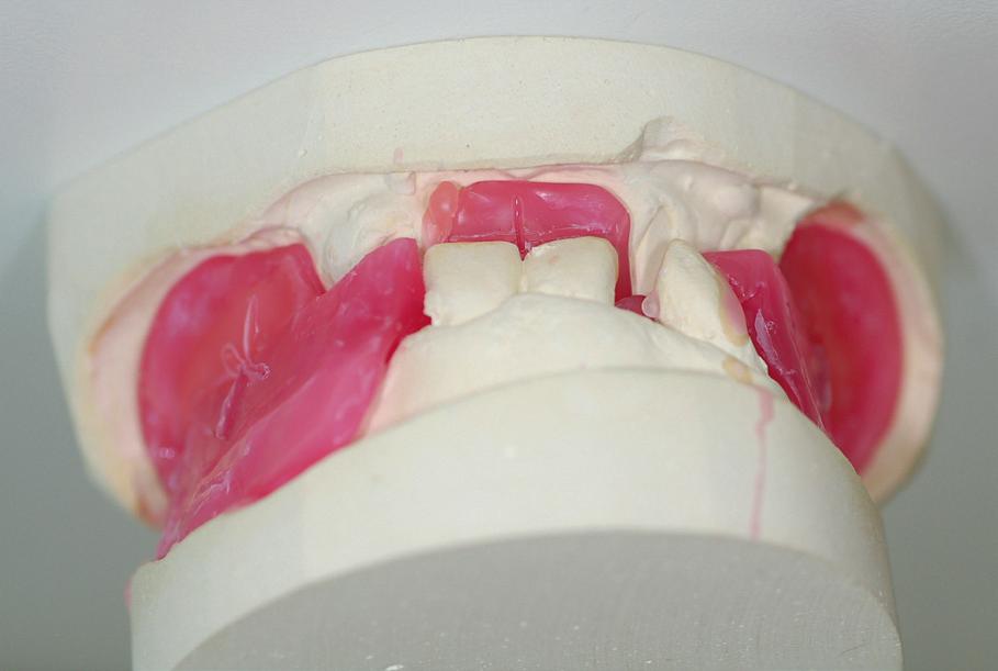 On the basis of the obtained data, the following diagnosis was made: according to Galasinska Landsbergerowa topographic classification, Class IV in the maxilla and mandible, according to Eichner s