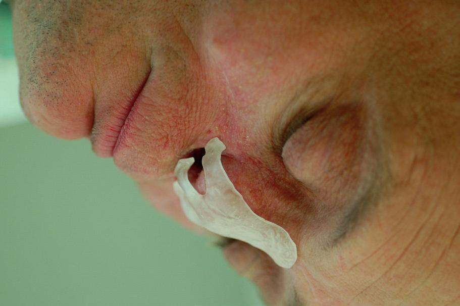 condition.10 According to Dreher s classification of postoperative tissues defects type V.