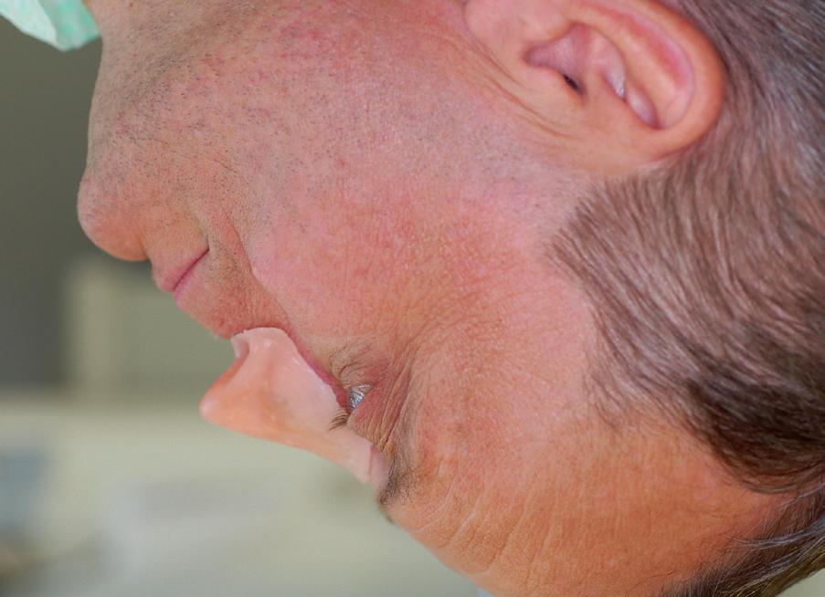 The analysis of occlusal conditions showed imbalance of occlusal surface, decrease in occlusal vertical dimension by approx. 6 mm, distoclusion with retrusion of the upper incisors and deep bite (Fig.