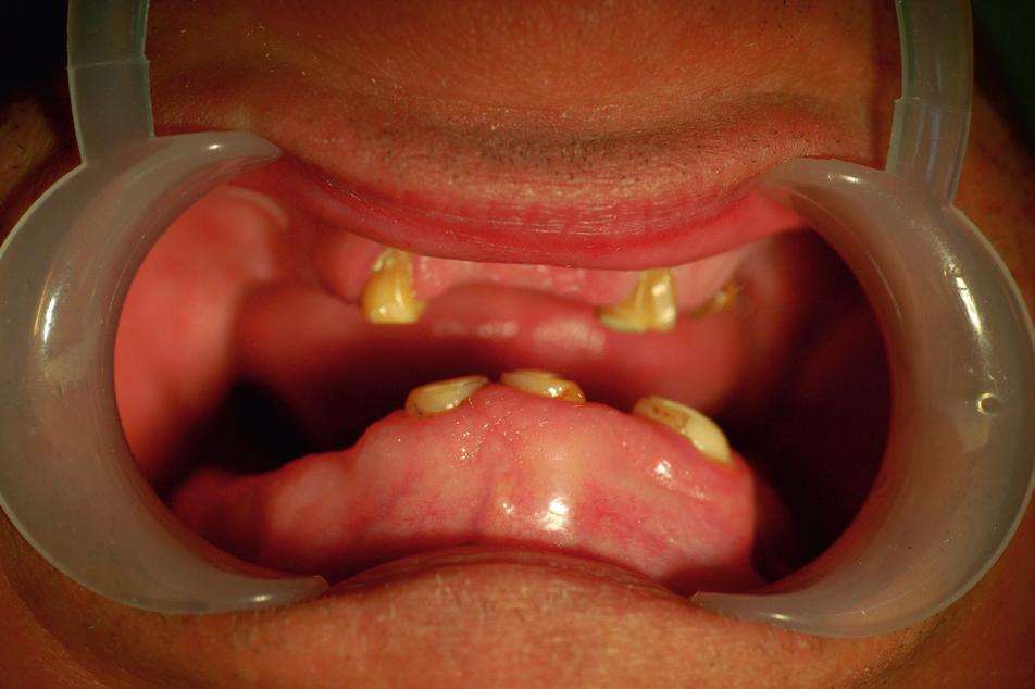 Comprehensive prosthetic rehabilitation of a patient with partial nose... J Stoma 2013; 66, 3 Fig. 7. View of patient s face after the use of nasal epithesis; a full face, b semiprofile, c profile.