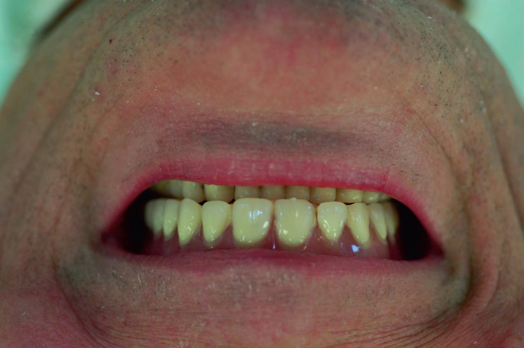 The patient approved the modelled shape of restoration (Fig. 6 a, b).