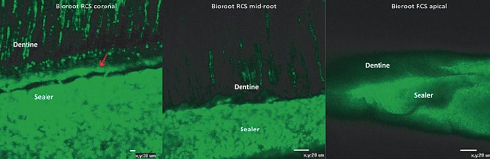 Fig. 4: Confocal microscopic images of BioRoot RCS interface with dentine at different levels along the root canal showing the mineral infiltration zone and sealer tags in dentinal tubules (Reprinted
