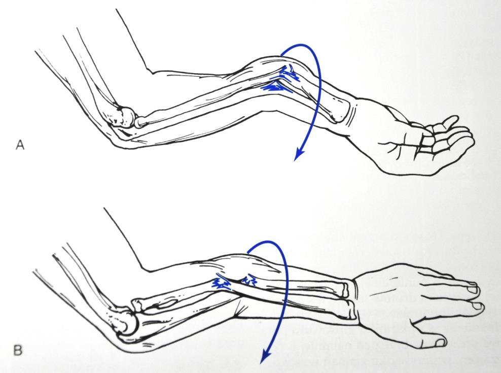 Znaczenie rotacji w mechanizmie złamania typu zielonej gałązki W przypadku złamań z przemieszczeniem dłoniowym odłam