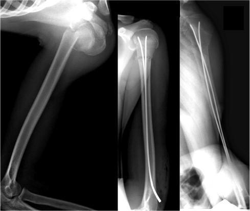 Śródszpikowa stabilizacja złamań przynasadowych kości ramiennej Przemieszczone złamanie przynasady bliższej (angulacja
