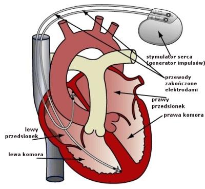 Implanty kardiologiczne w polu elektromagnetycznym środowiska pracy 3.2. Wszczepialne stymulatory serca 3.2.1.