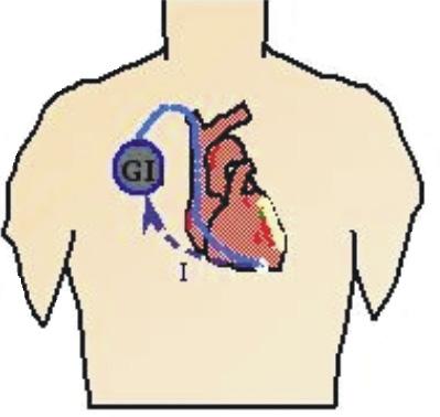 3. Wszczepialne urządzenia podtrzymujące rytm pracy serca elektrody, drugi pierścień elektrody jest zastąpiony
