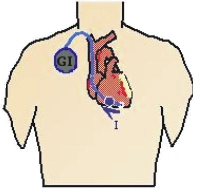Zatem prąd z elektrody przepływa od miejsca jej kontaktu z sercem (które jest pobudzane) do obudowy stymulatora