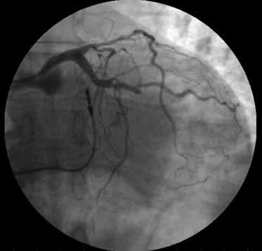U pacjentów ze współistniejącą niewydolnością serca (HF, heart failure) oraz przewlekłą chorobą nerek (PChN) zarówno diagnostyka, jak i leczenie są znacznie utrudnione i wymagają szczególnej uwagi,