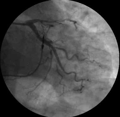 Rycina 3. Gałąź okalająca po angioplastyce Rycina 4. Gałąź przednia zstępująca po angioplastyce Rycina 5. Elektrokardiogram no skuteczny zabieg udrożnienia GO (ryc. 3) oraz angioplastyki GPZ (ryc.