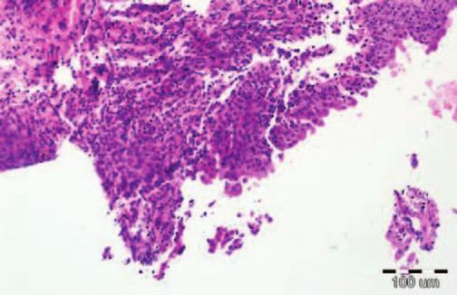 chronica activa medii gradus cum dysplasia urtohelii medii gradus).