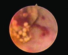 naciekający błonę śluzową (carcinoma urotheliale invasivum, High Grade G3), preparat