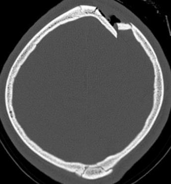 Diagnostyka obrazowe ostrych urazów głowy Złamania kości -