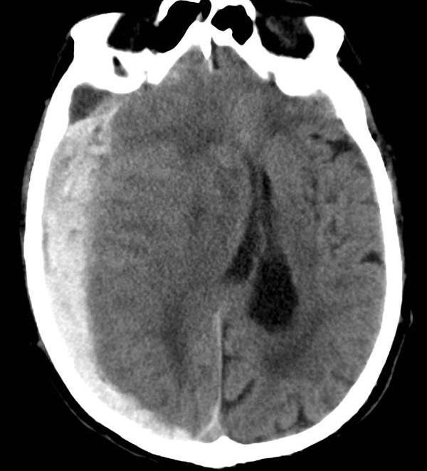 Primary Zmiany injuries urazowe in TBI pierwotne patients 1. Krwiak nadtwardówkowy (EDH) 2.