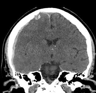 Primary Zmiany injuries urazowe in TBI pierwotne patients 1. Krwiak nadtwardówkowy (EDH) 2.