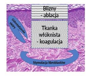 sku tecz ne go le cze nia wszy st kich ty pów skóry ze wszy st ki mi ro dza ja mi owło sie nia niż kil ka la se rów, z których każ dy przy no si ko rzy ści wy łącz nie nie którym ty pom pa cjen tów.