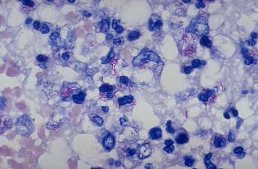 Mycobacterium
