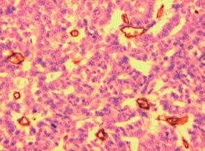 MVD in Serous Ovarian Cancer 739 solutions with concentrations decreasing to pure water.