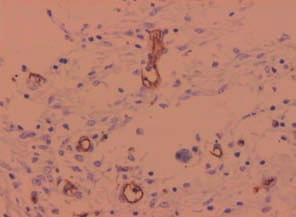 The second antibody and marker complex was obtained from Universal LSAB 2 KITS HRP, Rabbit/Mouse (liquid DAB) K 0675 manufactured by DAKO.