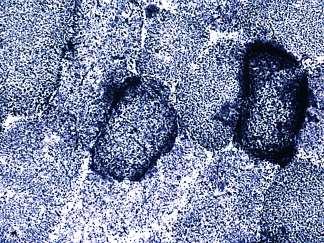 Mialgia w chorobach mitochondrialnych (2) Objawy ze strony układu mięśniowego: Ptoza, oftalmoplegia zewnętrzna, osłabienie mięśni kończyn i tułowia,