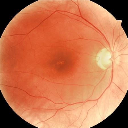 The cost-utility of telemedicine to screen for diabetic retinopathy in India. Ophthalmology. 2013;120(3):566-573. 12.