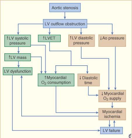 niewydolność LV Stenoza aortalna - patofizjologia stenoza aortalna zwężenie odpływu LV ciśn.skurcz.