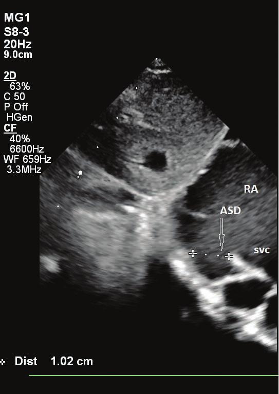 5. Angiografia tomografii komputerowej. Widok od przodu. Widoczne ujście z ył płucnych, poszerzona z yła pionowa i poszerzona z yła gło wna go rna ŻGG z yła gło wna go rna; Ż.