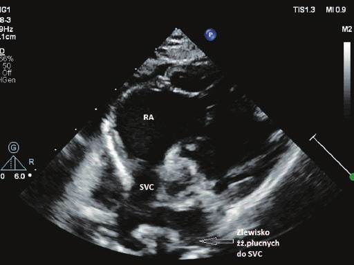 a Ryc. 6. Angiografia tomografii komputerowej. Widok od tyłu. Tro jwymiarowa rekonstrukcja ŻGG z yła gło wna go rna; Ż.  b Ryc. 4a, b.