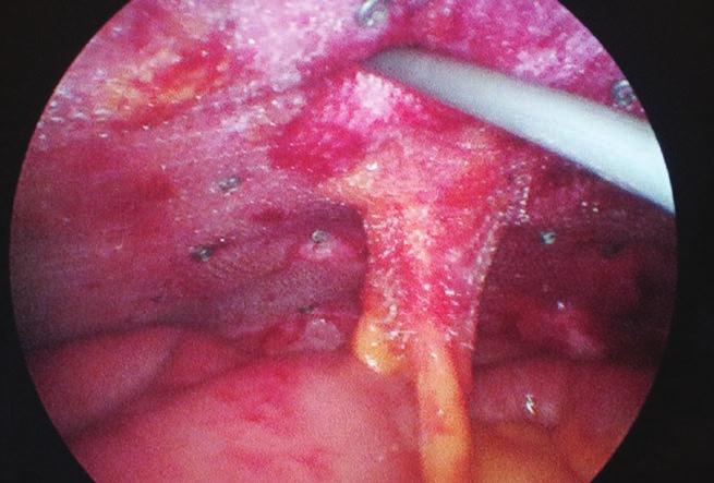Passing the stomal bowel through the opening in the mesh Ryc. 8.