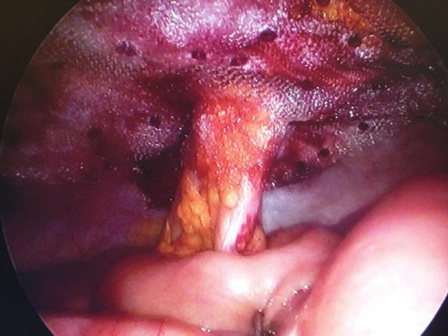 10. Siatka DynaMesh ufiksowana tackerami do otrzewnej Fig. 10. DynaMesh fixed with tackers to the peritoneum przepukliny pooperacyjnej.