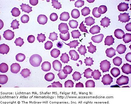 HUS/TTP: objawy PLT (zazwyczaj <20 000)* RBC LDH haptoglobiny