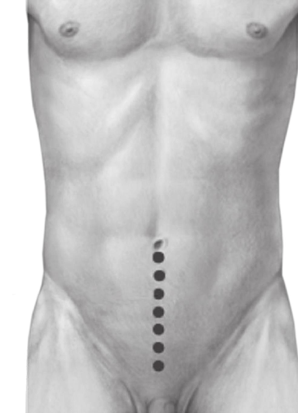 Prostata Ryc. 2. Położenie anatomiczne narządów miednicy mniejszej przed operacją Nacięcie skóry Zespolenie cewkowo- -pęcherzowe Ryc. 1. Cięcie skórne podczas prostatektomii radykalnej Ryc. 3.