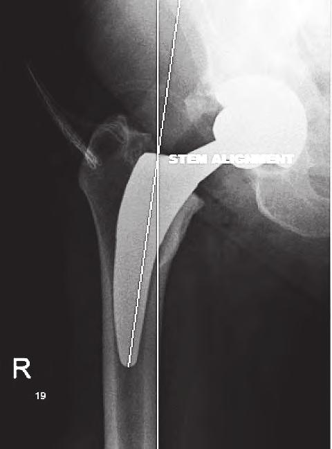 PRACA ORYGINALNA Chir. Narzadow Ruchu Ortop. Pol., 2017; 82(5) 160-164 Piotr Łuczkiewicz et al., Results of the Fitmore short-stem total hip arthroplasty at a minimum follow-up of 4 years Fig. 2. Stem alignment measurement technique.