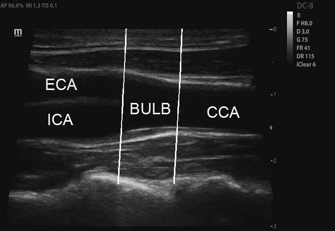 Grzegorz Madycki et al. Rycina 6. Odcinki tętnic szyjnych (opis w tekście); CC tętnica szyjna wspólna; EC tętnica szyjna zewnętrzna; IC tętnica szyjna wewnętrzna; UL opuszka podobojczykowych.