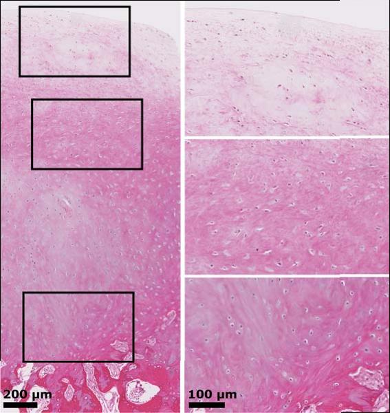 BST-CarGel a Microfracture Liczba ulepszonych parametrów ICRS ICRS I, 4 z 6 ICRS II, 10 z 14 Lepsze parametry struktury Architektura powierzchni Strefa powierzchniowa Integracja podstawowa Ocena
