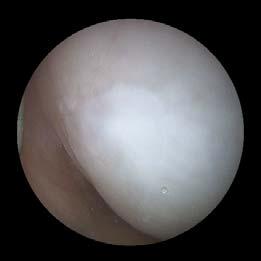 0 BST-CarGel Microfracture BST-CarGel : n=20 Microfracture: n=17 BST-CarGel Case Report