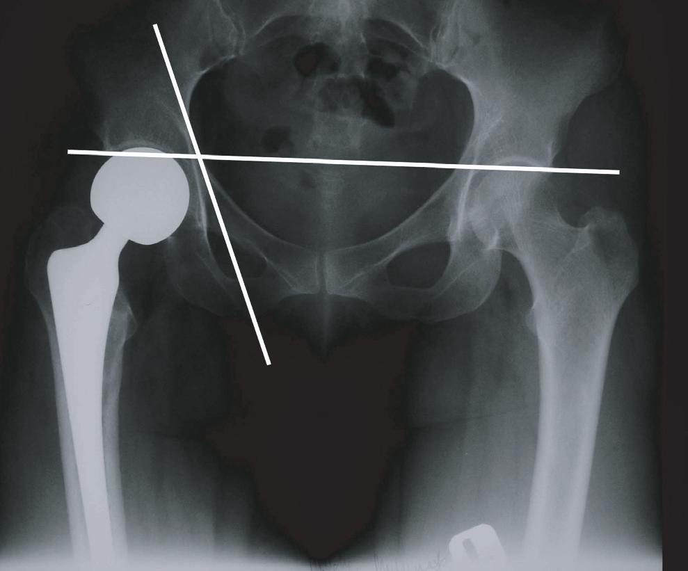 Krawczyk A. i wsp., Alloplastyka po³owicza z g³ow¹ eliptyczn¹ w leczeniu z³amañ szyjki i g³owy koœci udowej Ryc. 1. Metoda ocena erozji chrz¹stki stawowej panewki stawu biodrowego wg Wetherella i wsp.