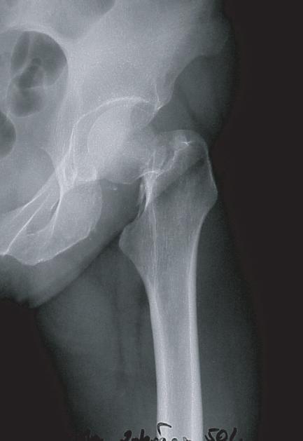 Two patients, one of whom suffered from a shortening and spastic paresis of the contralateral limb secondary to infantile cerebral palsy,