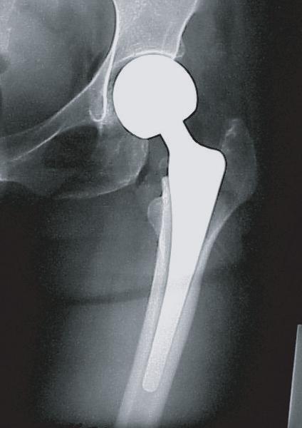 We applied Wetherell's radiometric method for the evaluation of the acetabular cartilage and migration of the prosthesis.