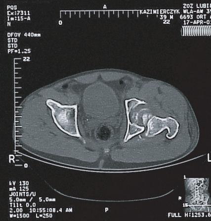 ; 50; female; leftsided femoral neck fracture, operated one week after the fracture; 44 mm elliptical head; Duofit stem; HHS functional score