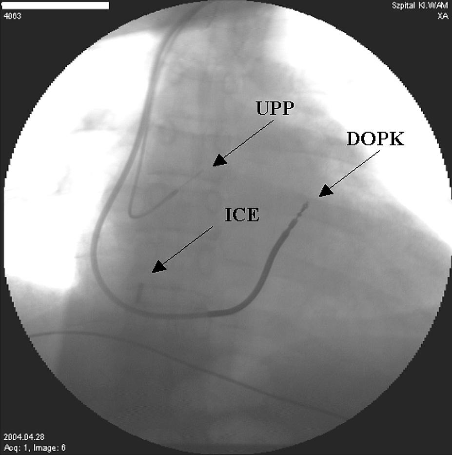 Folia Cardiol. 2005, tom 12, nr 2 umieszczono w drodze odpływu prawej komory pod kontrolą echokardiografii wewnątrzsercowej (ICE, intracardiac echocardiography).