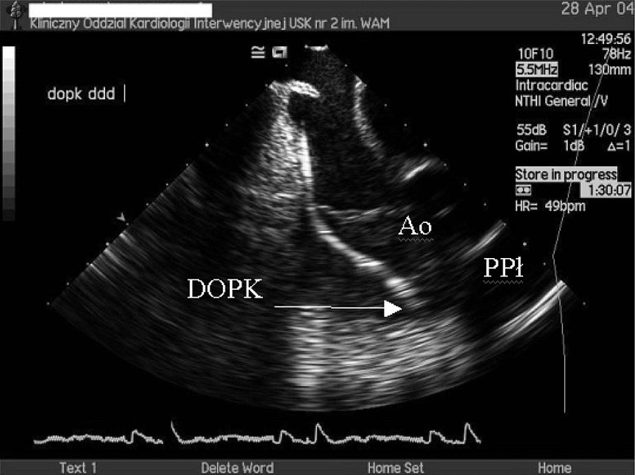 L. Markuszewski i wsp., Implantacja elektrody ICD w drodze odpływu prawej komory wyczuwania i skuteczną defibrylację impulsem 10 J.