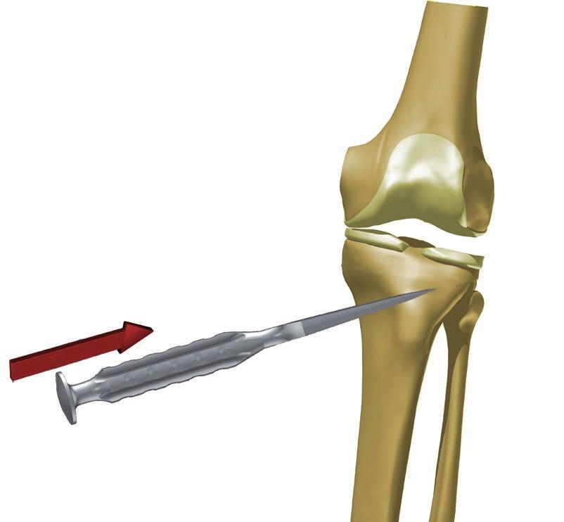 WYKONANIE WSTĘPNEGO NACIĘCIA KOŚCI PIŁĄ I WŁAŚCIWEGO OSTEOTOMEM Korzystając ze szczeliny na prowadzenie piły w celowniku [40.3974.200] należy wykonać wstępne nacięcie kości piszczelowej piłą.