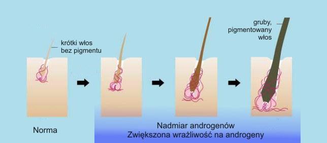 Wpływ androgenów na brodawkę włosa Receptory androgenowe znajdują się w brodawce włosa Ekspresja jest najsilniejsza w okolicach androgenozależnych owłosienia: w okolicy brody, skalpu (części podatnej
