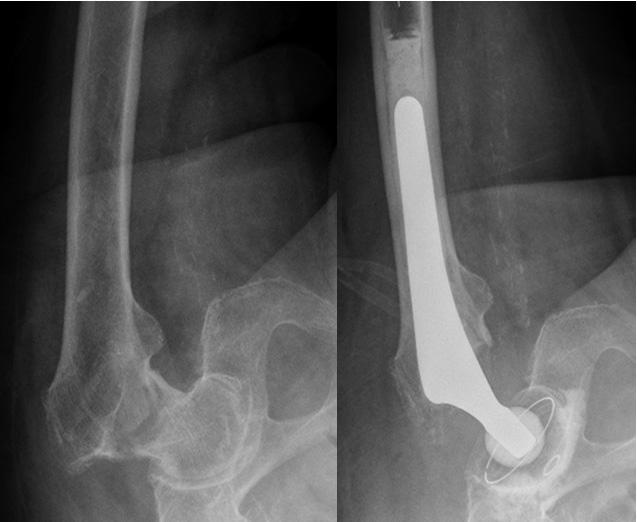 Fractures Ryc. 3.