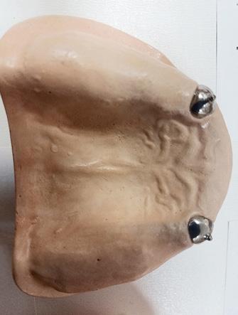Odzwierciedlenie dynamicznej sytuacji klinicznej pola protetycznego zachodzi w przypadku obecności implantów z zastosowaniem odpowiednich dla określonego systemu implantologicznego tzw.
