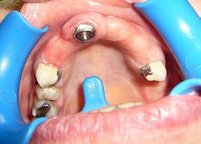 t ec h n i k a dentyst yc z n a Fot. 6. Przygotowana jama ustna do pobrania wycisku Fot. 7.