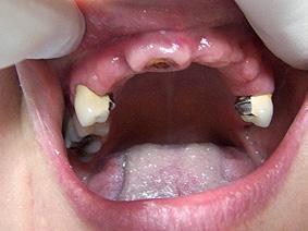 Proteza typu overdenture w jamie ustnej 6 7 8 9 10 11 12 Procedury laboratoryjne przy wykonawstwie protez overdenture opartych na wszczepach
