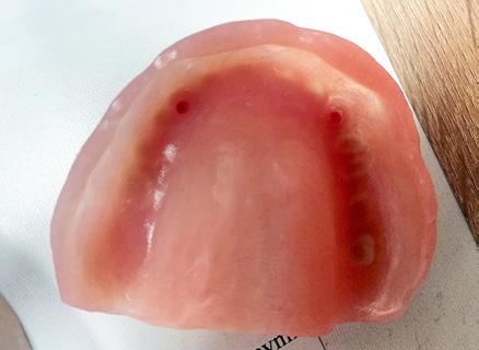 lowe analogi wszczepów umiejscowione w wyrostku zębodołowym, nachylone pod określonym kątem (warunkiem koniecznym jest kontrola ich