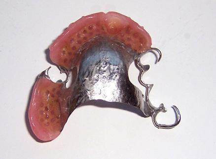 Wykonanie protezy overdenture opartej na zębach własnych pacjenta zaczyna się od wykonania wkładów koronowo-korzeniowych z zaczepem kulowym