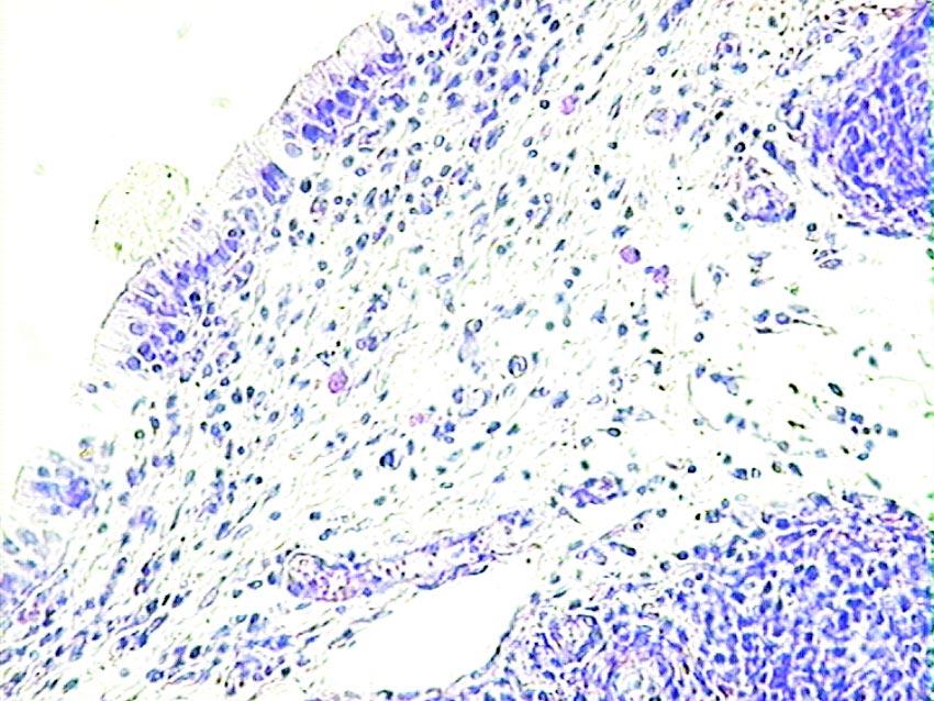 W ocenie badanego materia³u szczególn¹ uwagê poœwiêcono okreœleniu liczebnoœci i typu komórek nacieku zapalnego obecnych w zrêbie endometrium w poszczególnych kategoriach endometrosis.
